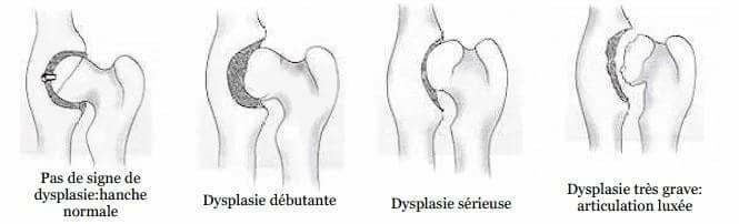 Dysplasie de la hanche (DC)